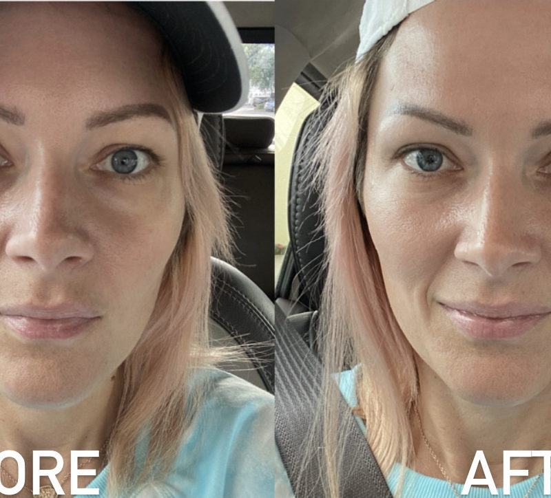 HydraFacial at Current Medical Spa